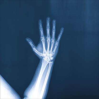 X-ray of a human hand and arm
