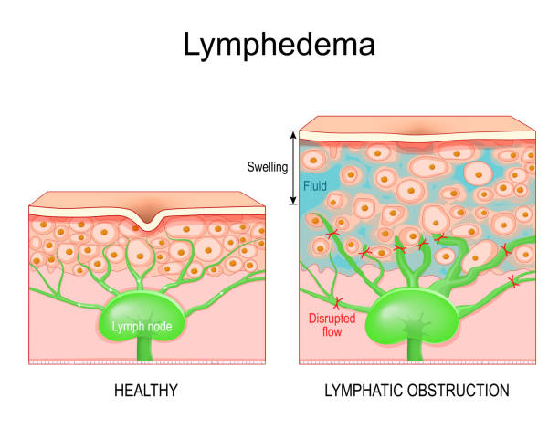 Lymphedema. Cross section of a human skin vector art illustration