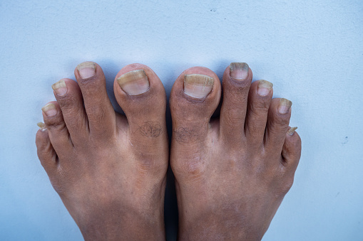 Oct.14th 2022 Uttarakhand, India. Neglected foot nails of an Indian adult with unhygienic feet conditions. Concept of self-care and personal hygiene.