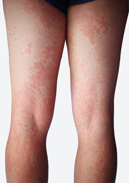 Dermatitis Dermatitis, Asian man, man pinches leg allergy, allergic reaction, insect bites, hand scratching, itchy red spots or skin rash. beauty problems from medical treatment erythema nodosum stock pictures, royalty-free photos & images