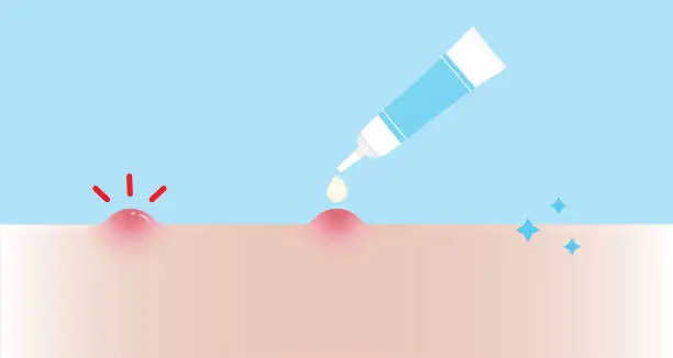 Vector illustration of Acne pimple treatment for papule vector illustration on sky blue background.