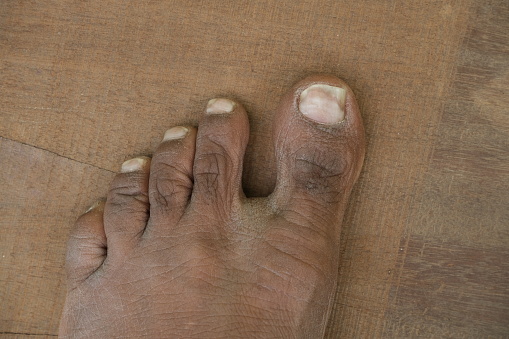 Psoriasis , Image of a man's feet on a wood background with fungal dermatitis on the toes causing peeling, scaly, itchy skin.