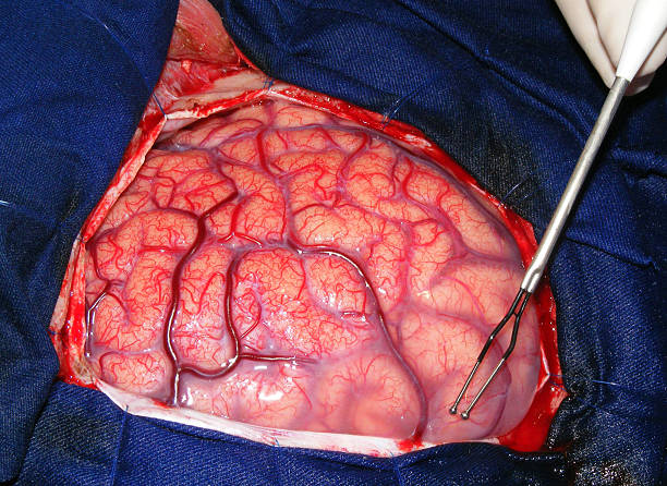 chirurgie du cerveau - epilepsy healthcare and medicine surgery sulcus photos et images de collection