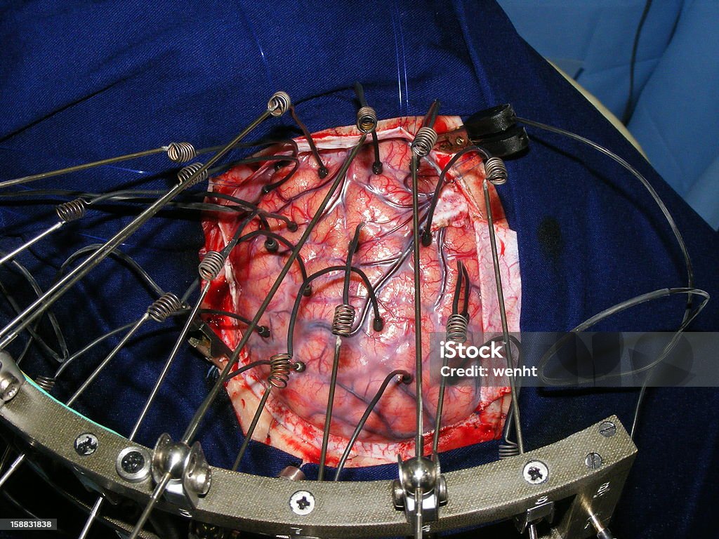 Chirurgie du cerveau - Photo de Opération chirurgicale libre de droits