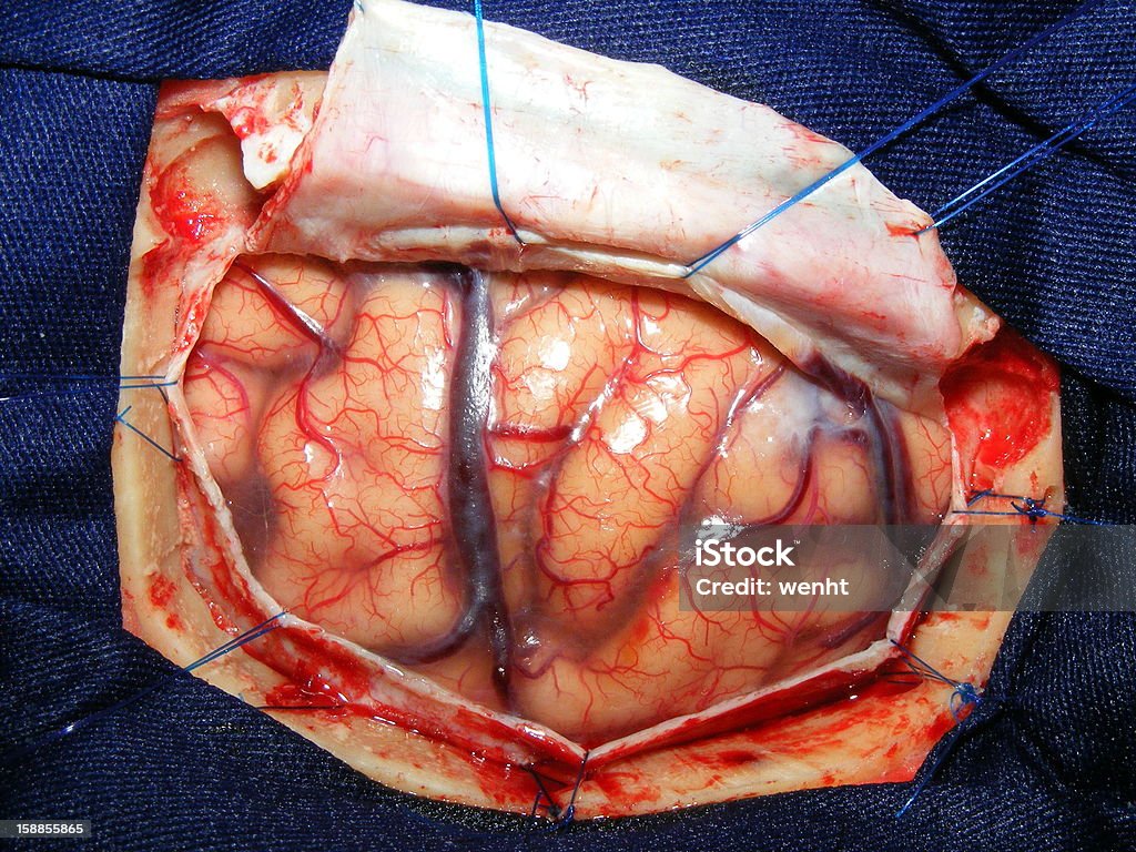 Gehirnchirurgie - Lizenzfrei Anatomie Stock-Foto