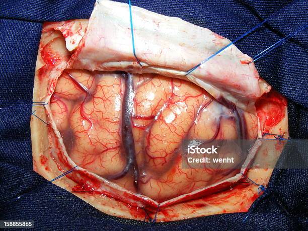 Operacja Mózgu - zdjęcia stockowe i więcej obrazów Anatomia człowieka - Anatomia człowieka, Bruzda mózgu, Chirurg