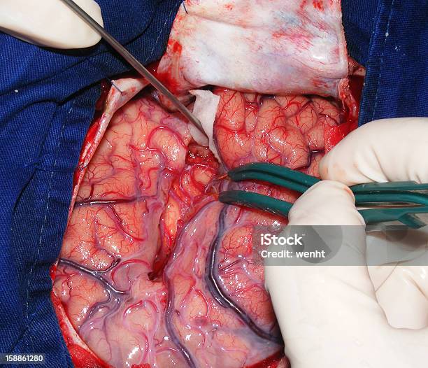 Neurosurgery 신경외과에 대한 스톡 사진 및 기타 이미지 - 신경외과, 수술, 뇌전증
