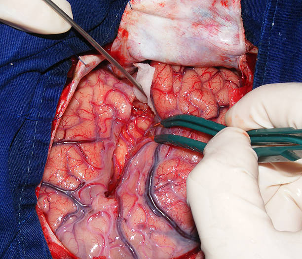 cirurgia cerebral - parietal lobe imagens e fotografias de stock