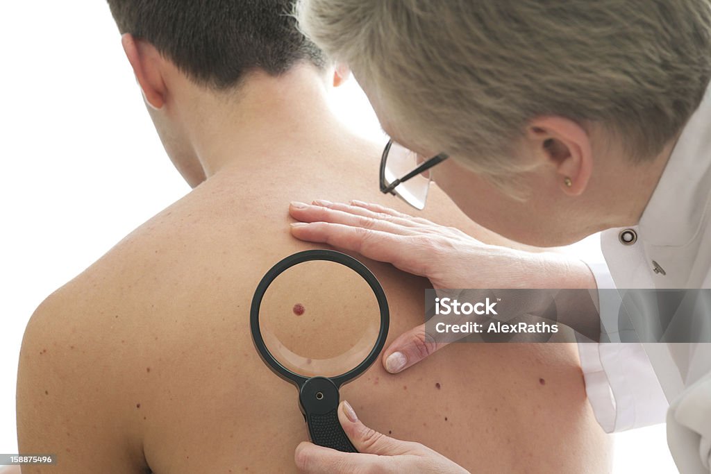 Dermatologen zusammengestellte Blick auf einer mole - Lizenzfrei Melanom Stock-Foto