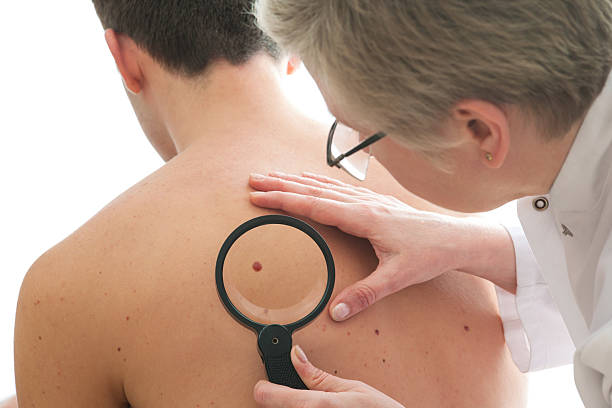 Dermatologist examines a mole Dermatologist examines a mole of male patient skin exame stock pictures, royalty-free photos & images