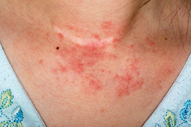 eczema haut am hals - toxicodermatitis stock-fotos und bilder