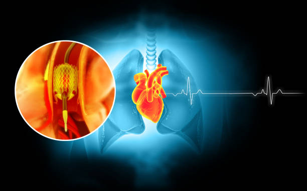 stentangioplastie auf wissenschaftlichem hintergrund. 3d-illustration - angioplasty stock-fotos und bilder