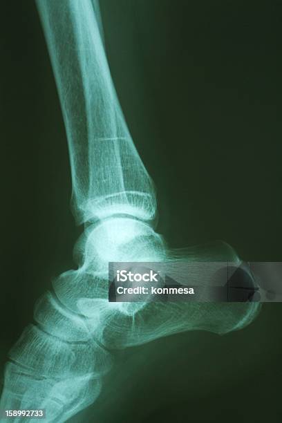 Foot Xray Stock Photo - Download Image Now - Anatomy, Ankle, Arthritis