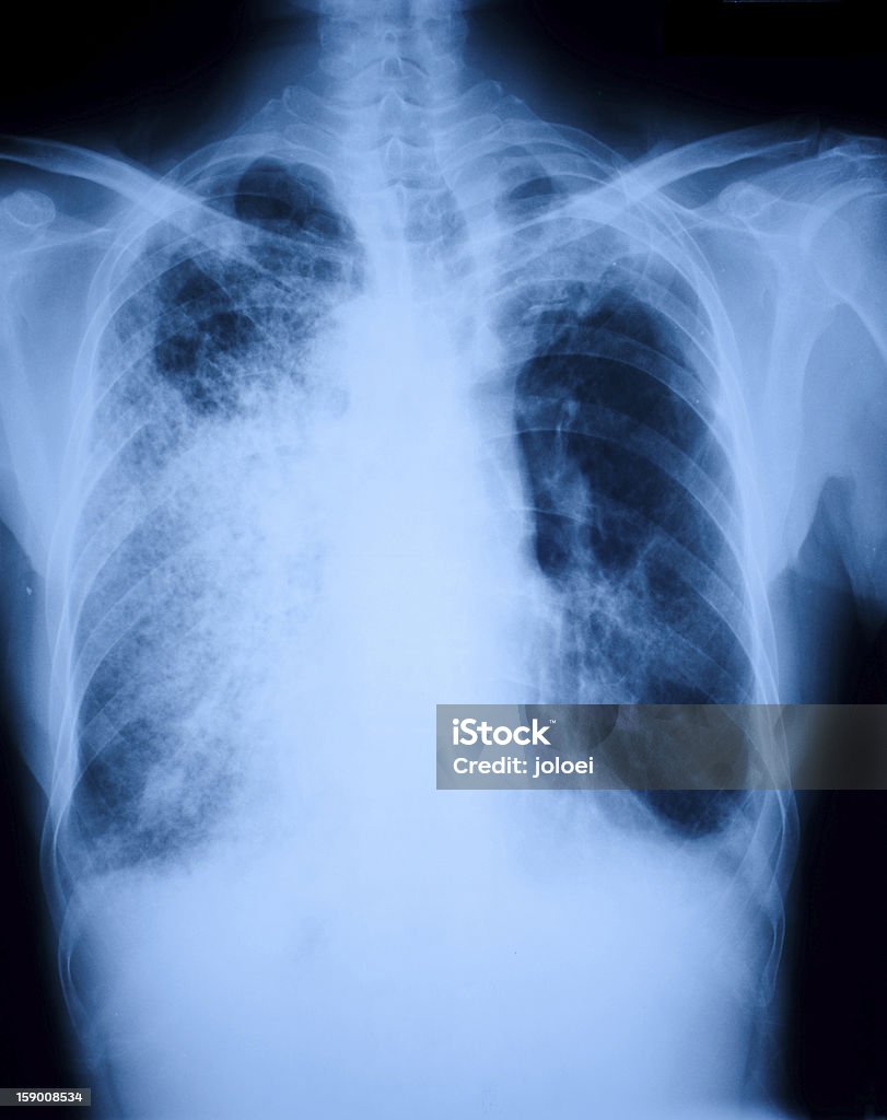 Polmonite i pazienti pellicola a raggi x - Foto stock royalty-free di Immagine a raggi X