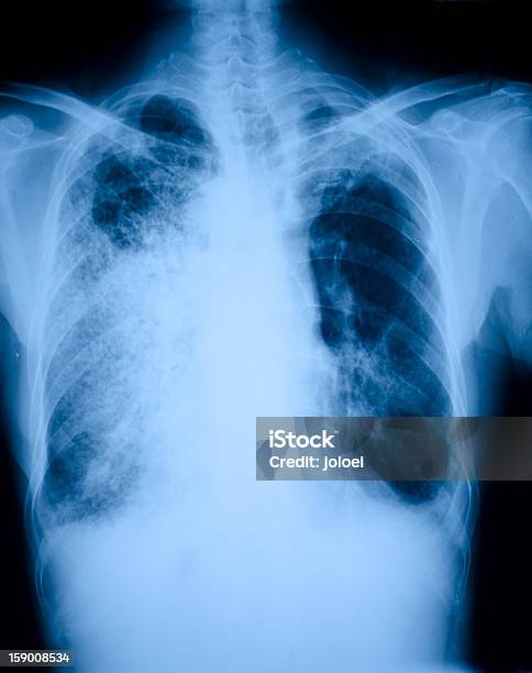 Pneumonia Patients X Ray Film Stock Photo - Download Image Now - Pneumonia, X-ray Image, Anatomy