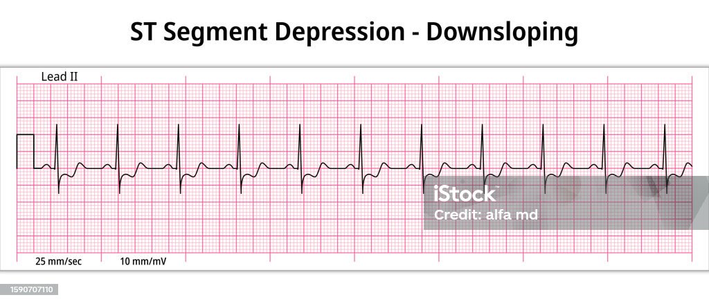 Signalis Depressed Ecg St Segment Depression Downsloping 8 Second Ecg Paper Stock ...