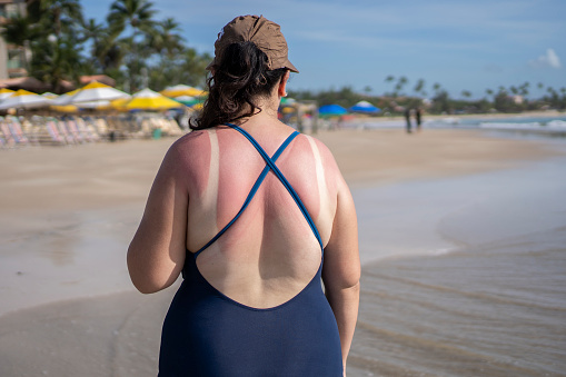 White woman with sunburn on the beach