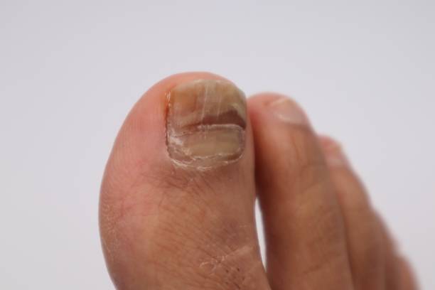 istock Injured nail close-up 1591207984