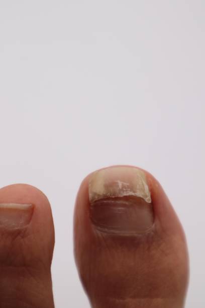 istock Injured nail close-up 1591208352