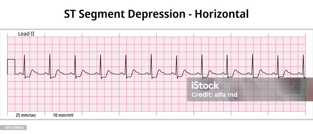 Ecg St Segment Depression Horizontal 8 Second Ecg Paper Stock ...