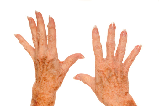 Female senior citizen hand with Rheumatoid Arthritis and age spots (also known as liver spots, Solar lentigo, Lentigo senilis and Senile freckle) shot on a white background