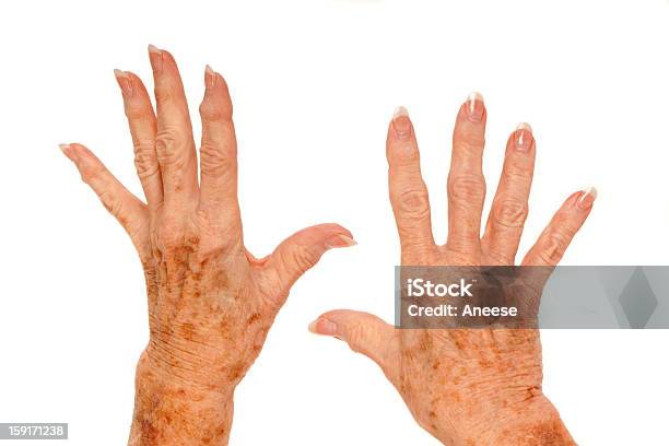 Medical Rheumatoid Arthritis And Liver Spots Stock Photo - Download Image Now - Liver Spot, Senior Adult, Scleroderma Fungus