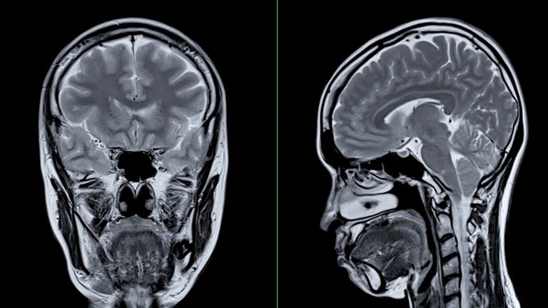Mri Scarry 4,300+ Skull Xray Stock Videos and Royalty-Free Footage - iStock