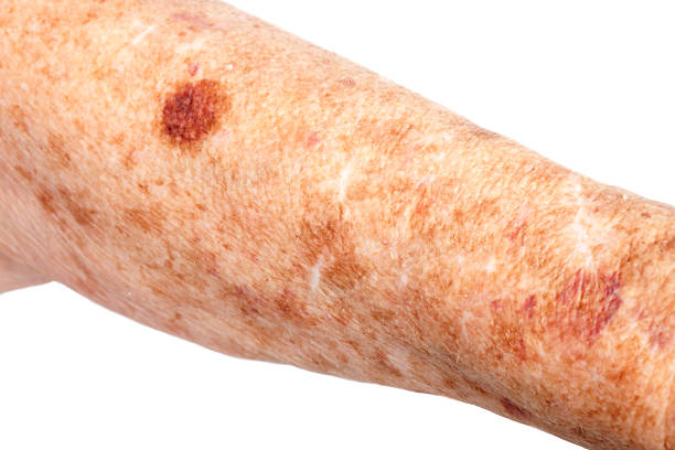 Medical: Liver Spots and Hematoma Female senior citizen arm with age spots (also known as liver spots, Solar lentigo, Lentigo senilis and Senile freckle) shot on a white background. The large dark bruise (contusion or hematoma of tissueis) caused buy blood thinning medication making the skin bruise easly, hematoma images stock pictures, royalty-free photos & images