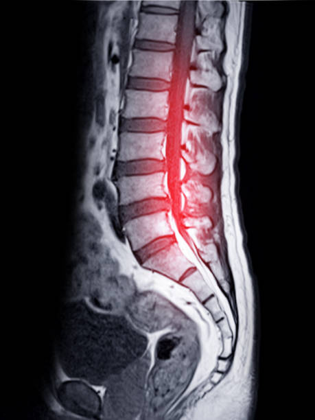 istock MRI L-S spine or lumbar spine Sagittall T1W view  for diagnosis spinal cord compression. 1591921849
