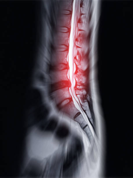 istock MRI L-S spine or lumbar spine Sagittall T2W view  for diagnosis spinal cord compression. 1591922376