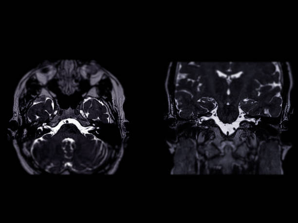 istock MRI Brain scan  with  the internal auditory canal (IAC) axial  and Coronal view. 1591923499
