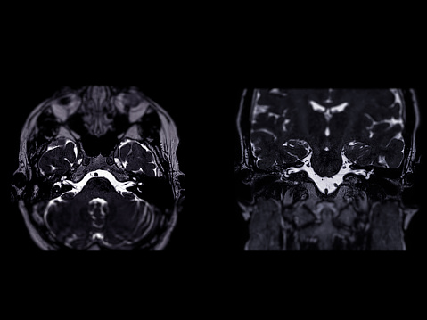 MRI Brain scan  with  the internal auditory canal (IAC) axial  and Coronal view.