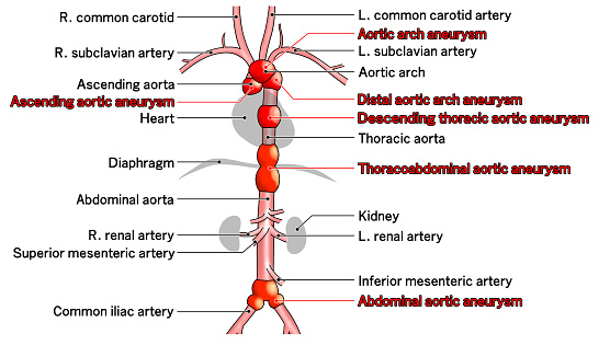 An illustration showing the approximate shape of the aorta