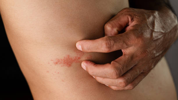 Man with shingles disease, skin infected with Herpes zoster, virus, Healthcare and medical. Man with shingles disease, skin infected with Herpes zoster, virus, Healthcare and medical. shingles rash stock pictures, royalty-free photos & images