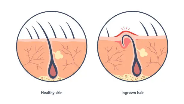 Vector illustration of Ingrown hair medical scheme under microscope