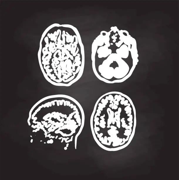 Vector illustration of Brain Scan Image Blackboard