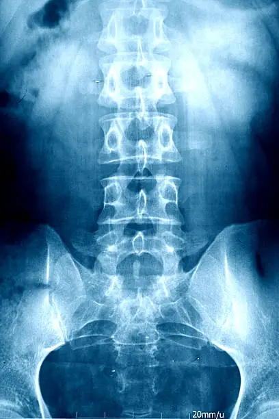 Photo of Xray