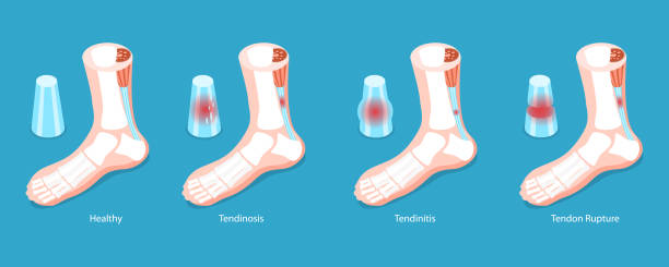 isometrische flache 3d-vektor-konzeptillustration der achillessehne - achilleus stock-grafiken, -clipart, -cartoons und -symbole