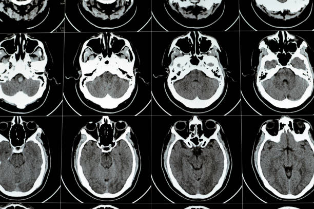 Multi slice CT scan of the brain showing Large brain stem and right centrum semiovale hematoma, normal posterior fossa structures, normal size of ventricular system and central mid-line structures, selective focus tomografía computarizada de múltiples cortes del cerebro que muestra hematoma semioval del tronco encefálico grande y centro derecho del centro, estructuras normales de la fosa posterior, tamaño normal del sistema ventricular y estructuras centrales de