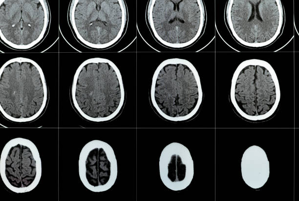 Multi slice CT scan of the brain showing Large brain stem and right centrum semiovale hematoma, normal posterior fossa structures, normal size of ventricular system and central mid-line structures, selective focus tomografía computarizada de múltiples cortes del cerebro que muestra hematoma semioval del tronco encefálico grande y centro derecho del centro, estructuras normales de la fosa posterior, tamaño normal del sistema ventricular y estructuras centrales de