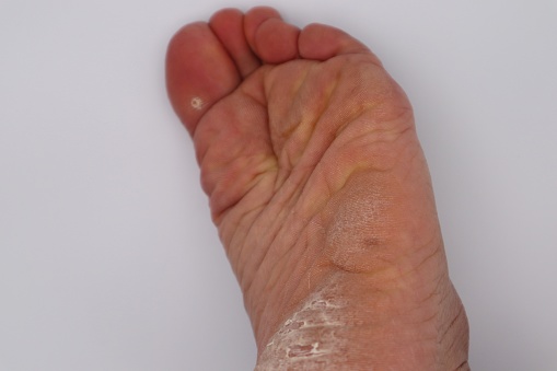 Close-up photo of a cracked heel