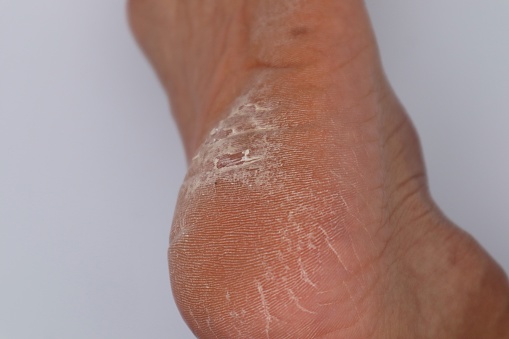 Close-up photo of a cracked heel