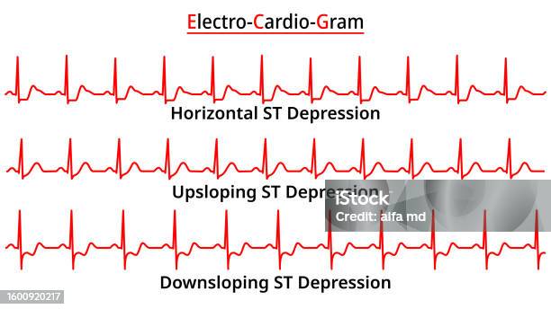 Set Of Ecg Common Abnormalities St Segment Depression Upsloping ...
