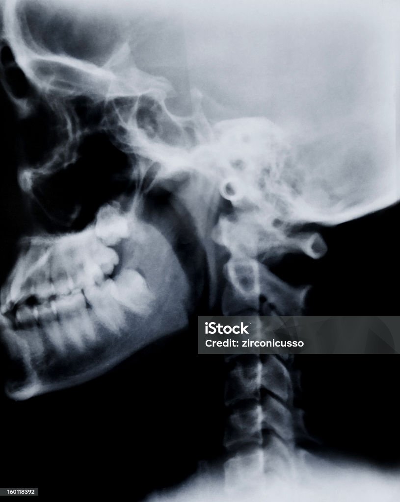 X-Ray film Human head on black and white x-ray film Anatomy Stock Photo