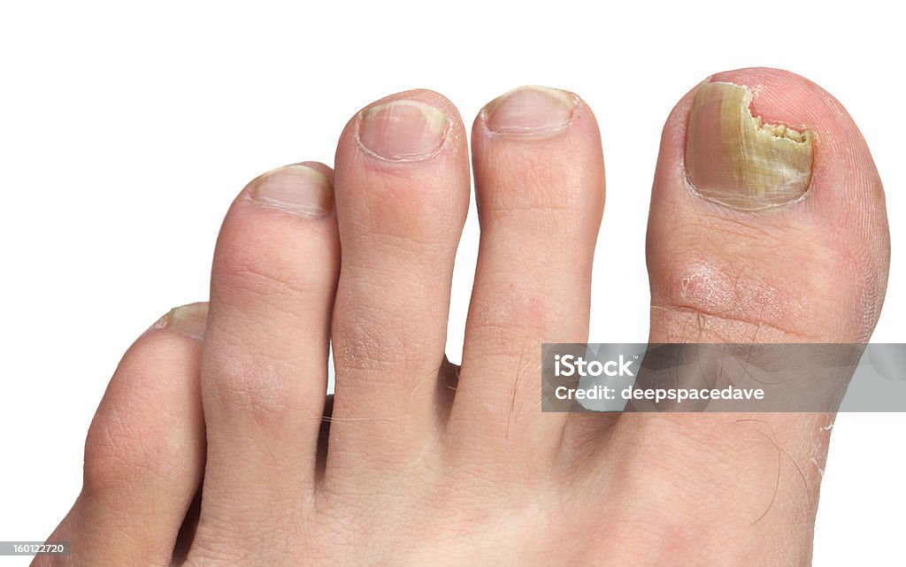 Toenail Fngus at Peak Infection A toenail fungus at the peak of the infection. Fungus Stock Photo