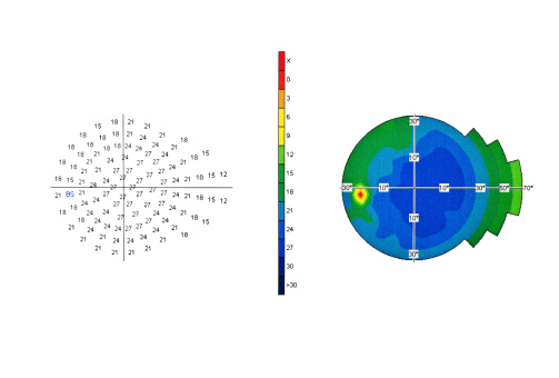 Visual Field in Glaucoma