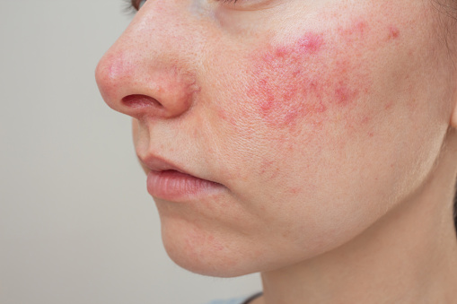 close-up profile of a young Caucasian woman suffering from the skin chronic disease rosacea on her face in the acute stage. Dermatological problems.  isolated on a beige background