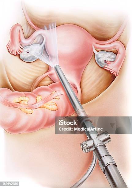 Laparoscopiafêmea Órgãos - Arte vetorial de stock e mais imagens de Cuidados de Saúde e Medicina - Cuidados de Saúde e Medicina, Exame Ginecológico, Fertilidade Humana