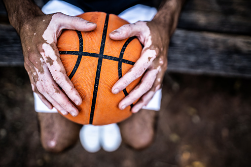 Hands of a man with vitiligo holding basketball