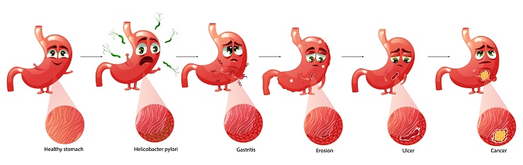 Stomach diseases. Cartoon character with emotions. Diagram diseases helicobacter pylori, gastritis, erosion, ulcer, cancer. Educational anatomical vector illustration isolated white background.